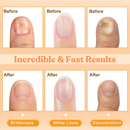 LOVILDS™🎉NEW YEAR SALE🎉Save up to 70% 🅾🅵🅵 Bee Venom Nail Repair Treatment Spray